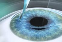 Как проводится лазерная коррекция зрения по разным методикам и сколько стоит процедура?